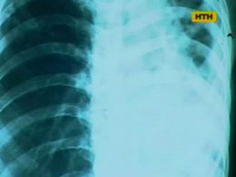 Хворі на туберкульоз українці не отримують необхідних ліків