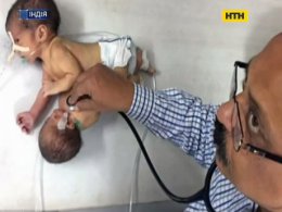 Дві голови та одна печінка - в Індії народилися сіамські близнюки