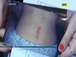 Педагогічний скандал у Запоріжжі - виховательку звинувачують у побитті дитини