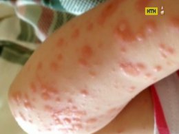 Как не привезти с экзотического курорта вместе с загаром страшные болезни