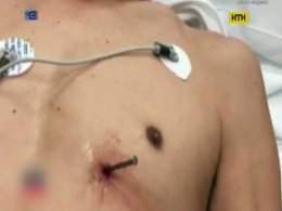 Американец самостоятельно добрался в больницу с гвоздем в груди