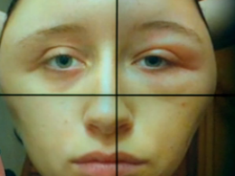 Из-за аллергии на краску для волос у женщины раздуло лицо