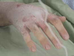 Революция в медицине: ученые создали искусственную кожу, которая залечивает раны