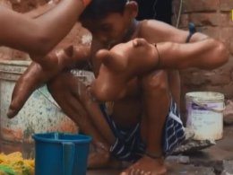 Хлопчик із найбільшими в світі кистями рук мешкає в Індії