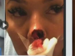 В Канаде парень откусил нос своей девушке из-за ревности