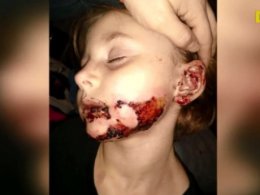 6-річна дівчинка отримала опіки майже половини обличчя через гру із санітайзером для рук