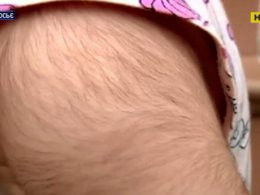 20 іспанських малюків вкрилися густим волоссям через помилку лікарів