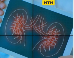 Лікарі попереджають уже про нову можливу епідемію ниркової недостатності